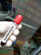 Blood sample for QuantiFERON-TB Gold test for diagnosis of Tuberculosis, latest name  IGRA