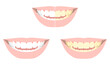 歯の色（白～黄色）まとめ