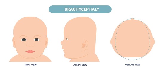 Wall Mural - craniosynostosis helmet pillow flat head autism brain skull bone deformity baby infant child newborn defect birth anterior Metopic Born genes genetic position sleep shape deformation tummy time 