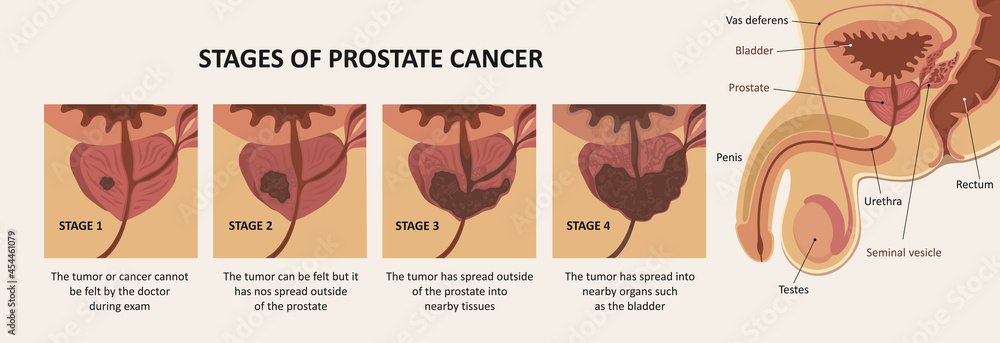 Stages of prostate cancer. Anatomy of the male reproductive system ...