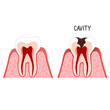 cavities teeth