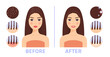 Beautiful Brunette Woman with Dandruff on Hair. Treatment of Scalp. Before and After. Seborrhea Icons. Happy Lady with Clean Hair, with a Smile on Face. Cartoon Style. White background. Vector image