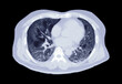  CT scan of Chest or lung axial view of lung infection covid-19 with ground glass opacity isolated on black background. clipping path.