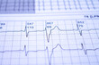 Heartbeats represented on graph paper. Electrocardiogram with selective focus.