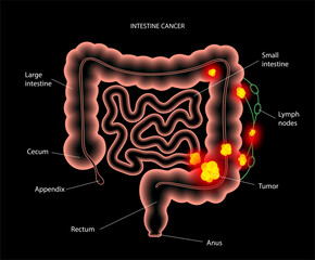 Wall Mural - Intestine 3D cancer