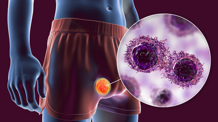 Poster - Testicular cancer, 3D illustration