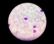Photomicrograph show Auer rods seen in acute myeloid leukemia. Myeloblasts