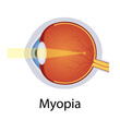 Myopia and Vision Disorders Illustration. Eyes Defect Concept. Detailed Anatomy Eyeball with Myopia Defect. Isolated Vector
