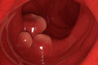 Large tumors on the colon wall in colorectal cancer closeup view 3d illustration
