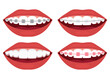 teeth alignment. Metal, ceramic, plastic, ligature and invisible braces