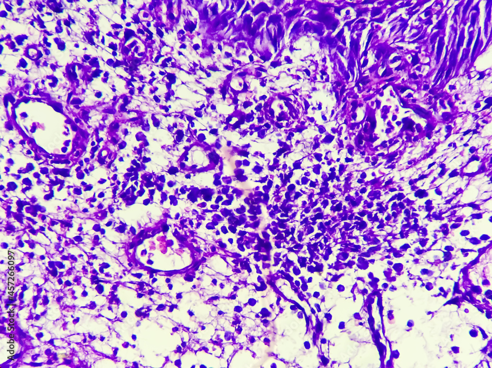 Cancer of Esophagus: Poorly differentiated adenocarcinoma in a patient ...