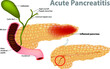 Acute Pancreatitis caused by gallstone. Gallstones block the flow of pancreatic juices into the duodenum.