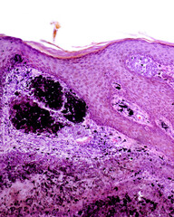 Poster - Intradermal pigmented nevus