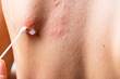 © sashka1313 - cotton swab treatment of skin rash. Shingles, varicella-zoster virus. skin rash and blisters on body. Skin infected Herpes zoster virus. Herpes Virus on body. urticaria rash. atopic dermatitis