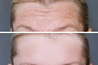 Deep mimic forehead wrinkles before and after treatment, smoothing and correction of face wrinkles as a result of rejuvenation or injection botulinum toxin