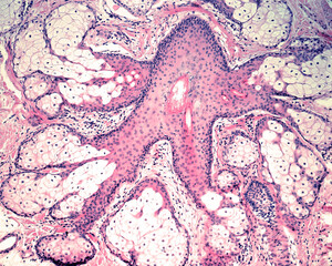 Wall Mural - Pilosebaceous unit. Sebaceous gland