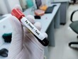 Biochemist of doctor holds blood sample for Transferrin test. Iron deficiency anemia, TIBC. Medical test tube in laboratory background.