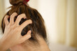 A woman has problems with hair and scalp,she has dandruff from allergic reactions to shampoos. and hair conditioner