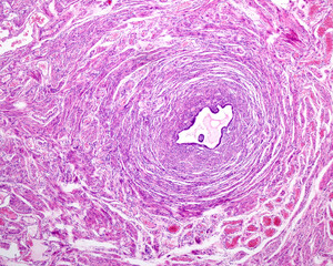 Sticker - Intramural uterine tube