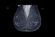  X-ray Digital Mammogram  or mammography  both side of the breast  MLO view  for diagnonsis Breast cancer in women isolated on black background.