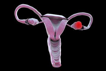 Sticker - Ovarian cancer, 3D illustration