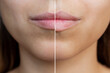© Марина Демешко - Cropped shot of young women's face with lips before and after lip enhancement. Injection of filler in lips. Close-up