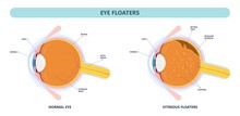Eye Floaters Fluid Vision Retina Myopia Trauma Surgery Loss Of Light Tear Torn Laser Surgical Repair Older Detached Blurry Shadow Pain Injury Hole Macular Age Treat Blood Dark Lose Wear Pars Plana