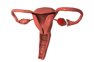 Sticker - Ovarian cancer, 3D illustration