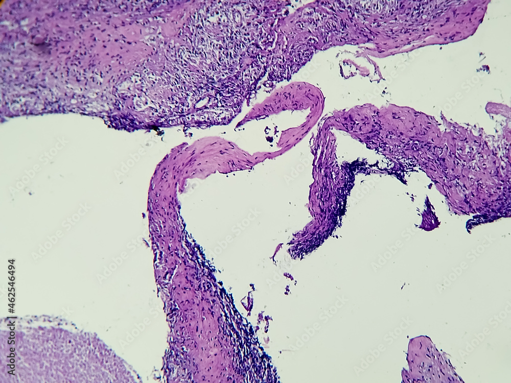 Breast Cancer Awareness, ductal carcinoma in situ (DCIS): Tumor cells ...