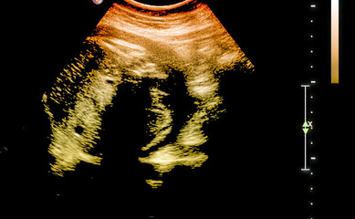 Sticker - Ultrasound of fetus in third month pregnancy