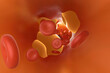 © Westend61 - Three dimensional render of artery clogged by cholesterol