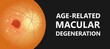 macular degeneration hemorrhage dry wet Age hole pucker edema eye vision loss AMD retina drusen blind spots Blood vessels leak blurry adult lose visual field exam treat contact lens myopia older tear
