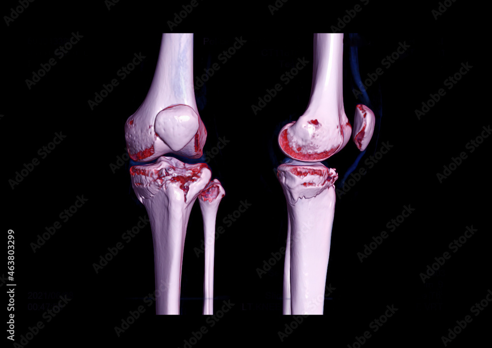 Compare AP and lateral view of CT knee joint 3D rendering image showing ...
