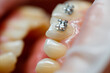 The orthodontist puts metal braces on the patient's teeth. Orthodontic dental treatment. High quality photo