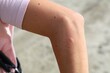 Mosquito bite woman's arm