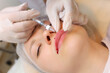 © Roman - The cosmetologist holds the client's upper lip with two fingers, twisting it to inject hyaluronic acid. Droplets of blood stood out from the previous injection on his lip