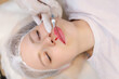 © Roman - The beautician inserted a needle from the syringe all the way to its base to evenly distribute the hyaluronic acid in the client's lips