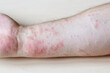 sample of Allergic contact dermatitis - itchy rash on side of forearm close up