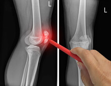 Close Up X-ray Knee AP-Lateral Showing Fracture Patella Or Knee Cap. Pain In A Man, Doctor Holding A Red Pen Point , Symptoms Medical Healthcare Concept.