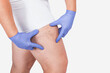 Man in blue gloves shows  the dilation of small blood vessels of the skin on the leg. Medical inspection and treatment of Telangiectasia. Phlebeurysm.