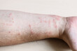 © vvoe - sample of Allergic contact dermatitis - skin inflammation on inner side of forearm close up