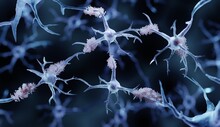 Amyloid Plaques In Alzheimer's Disease