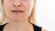 © Angelov - Real skin Biorevitalization on white background. Traces of biorevitalization injections on woman face. Biorevitalization needle marks Beauty treatment, real papules after hyaluronic injection.