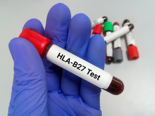 Canvas Print - Blood sample tubes for HLA-B27 test, diagnosis for autoimmune disease. chronic joint pain