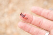 © epovdima - Injured finger with bleeding open cut