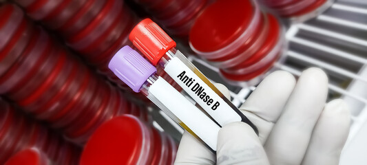 Poster - Blood sample for Anti-DNase B or ADN-B test, anti deoxyribonuclease-B antibody, Group A Streptococcus infection