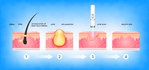 Acne scar vascular laser treatment. Inflammation associated with pimples. The structure of the skin acne scar. Medical beauty skin care concept. 3D vector illustration.