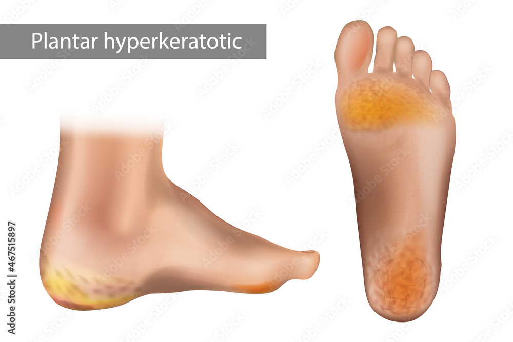 Plantar or Palmoplantar hyperkeratosis. Keratoderma. Vector ...