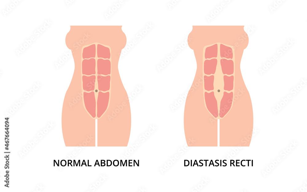 Split Belly Button Normal toned abdomen muscles and diastasis recti, also known as ...