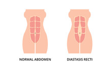 Normal Toned Abdomen Muscles And Diastasis Recti, Also Known As Abdominal Separation, Common Among Pregnant Women